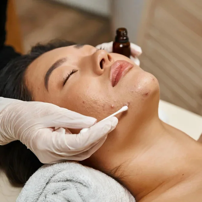 Advanced Acne and Acne Scar Treatment