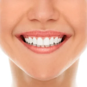 Dental Veneers