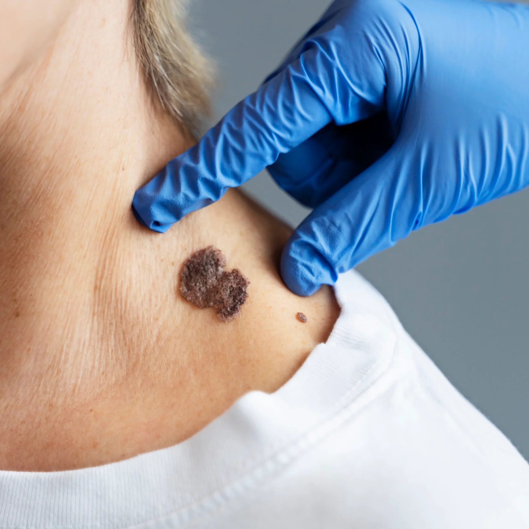 Dermatosurgical Procedures