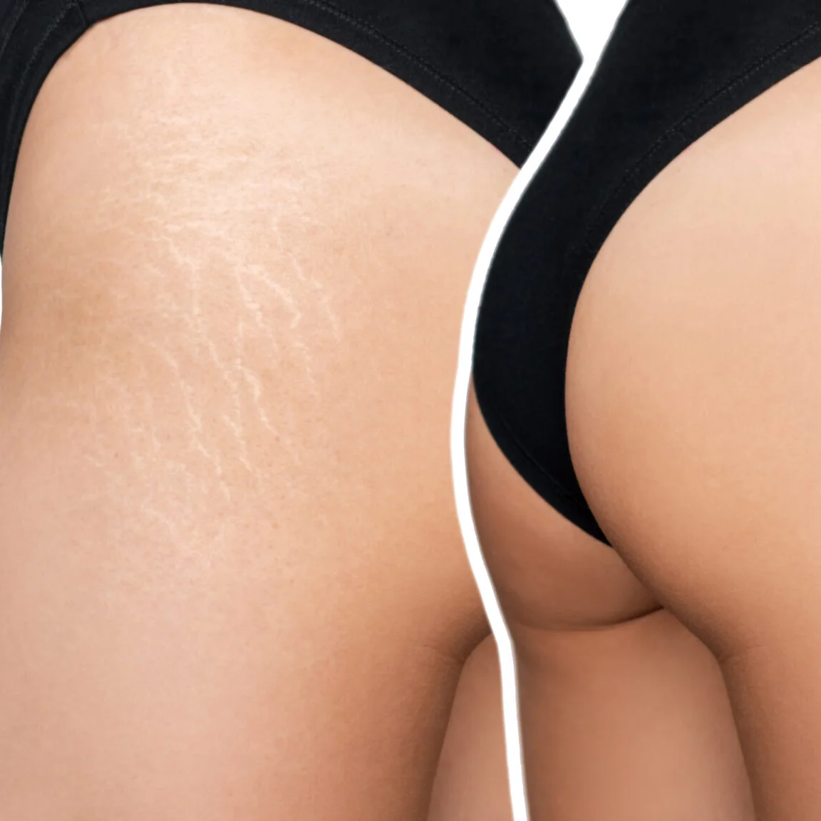 Stretch Marks Reduction